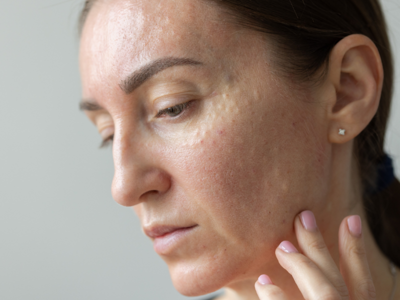 Face Derretida: Como Recuperar o Contorno Facial?