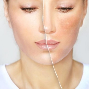 Tratamentos para Manchas em Petrópolis