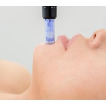 Microagulhamento em Petrópolis