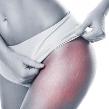 Tratamentos para Estria em Petrópolis