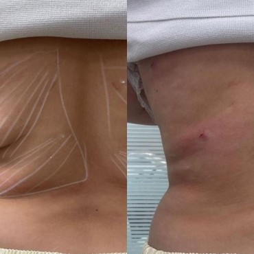 Endolifting em Petrópolis