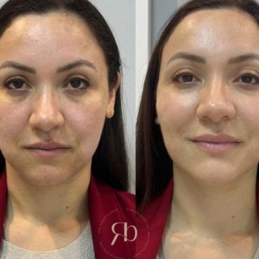 Derretimento de Face em Petrópolis