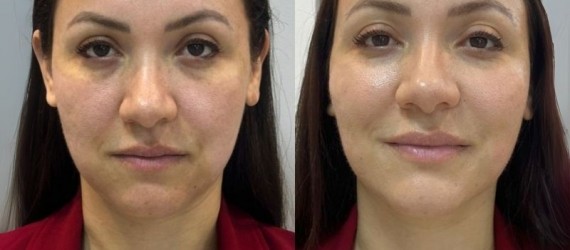 Derretimento de Face